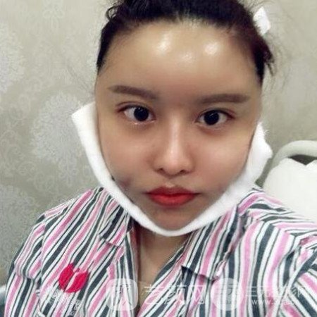 成都銅雀臺(tái)雷剛吸脂瘦臉一個(gè)月案例分享~